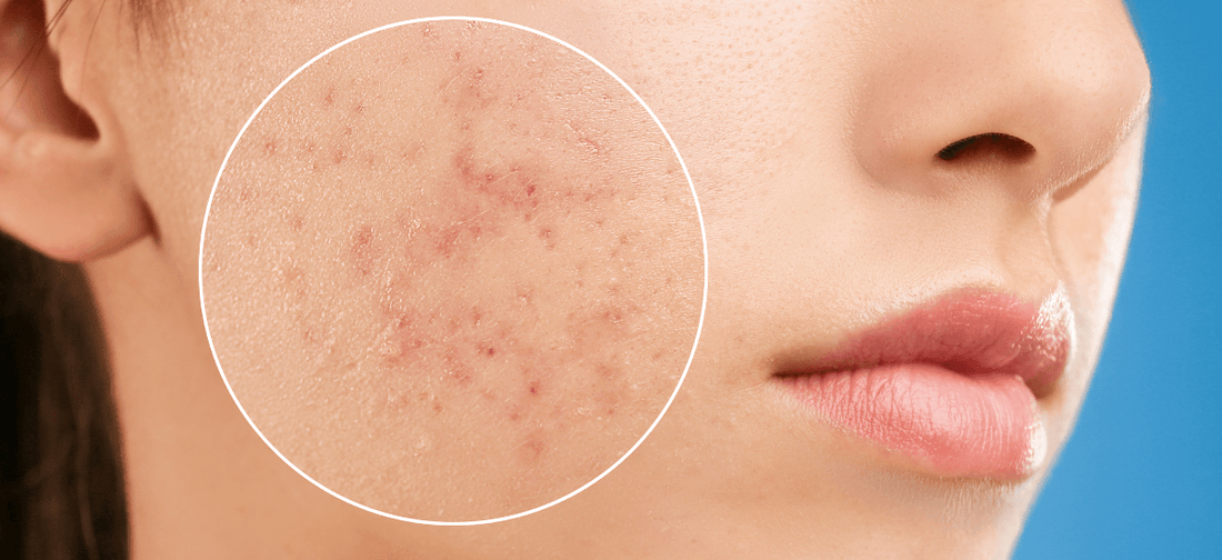 Close-up of young woman’s cheek with visible acne and skin imperfections highlighted in circle