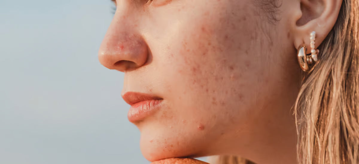 Faces with visible acne scars